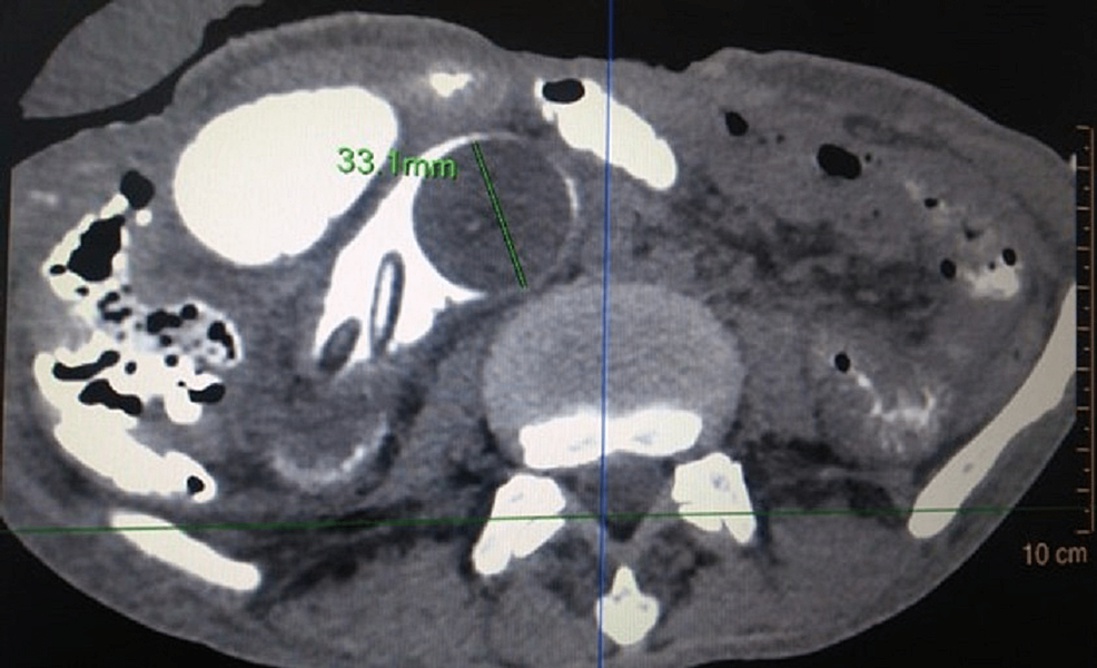 Cureus Spontaneous Enteral Migration of a Feeding Jejunostomy Tube
