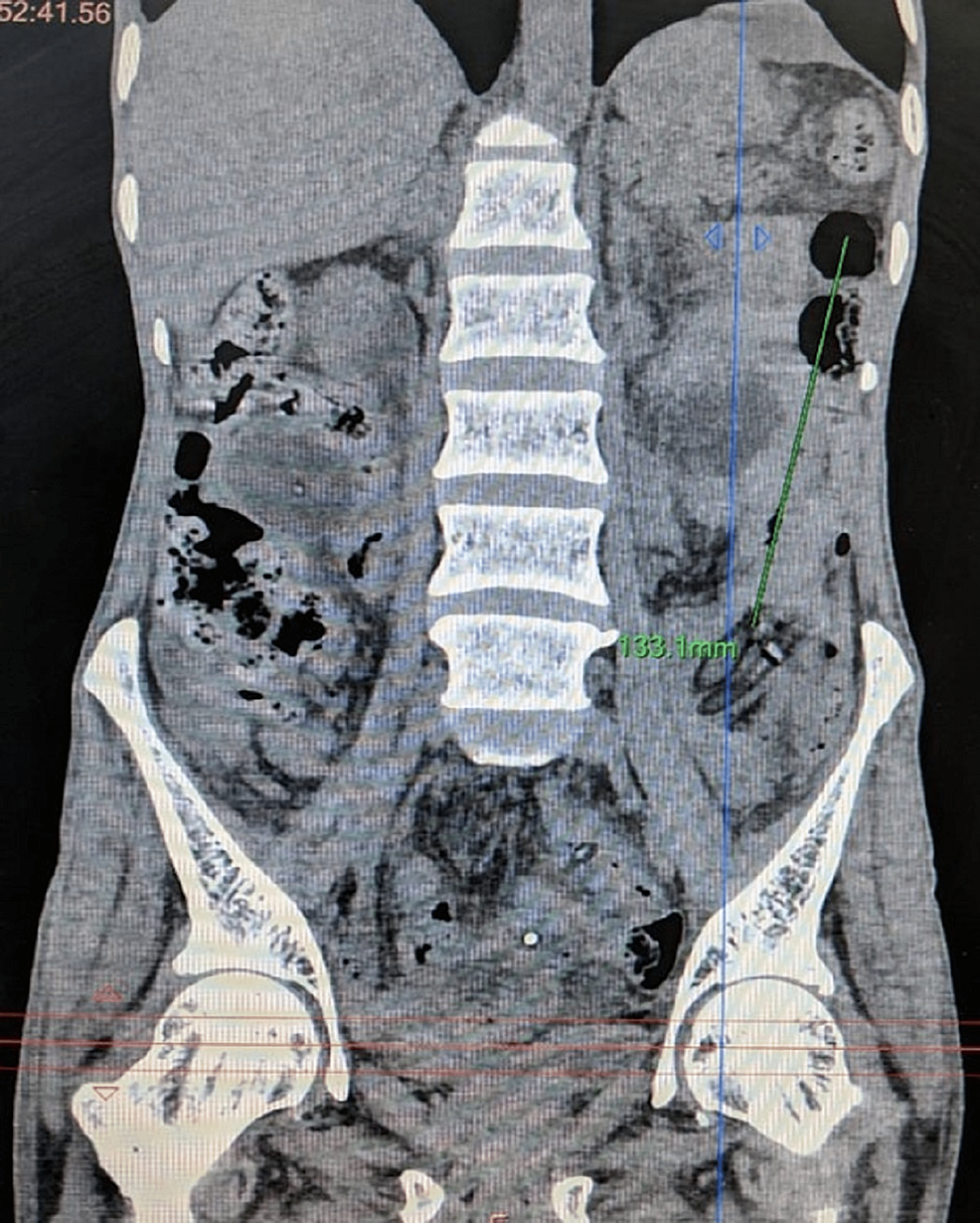 Cureus Spontaneous Enteral Migration of a Feeding Jejunostomy Tube
