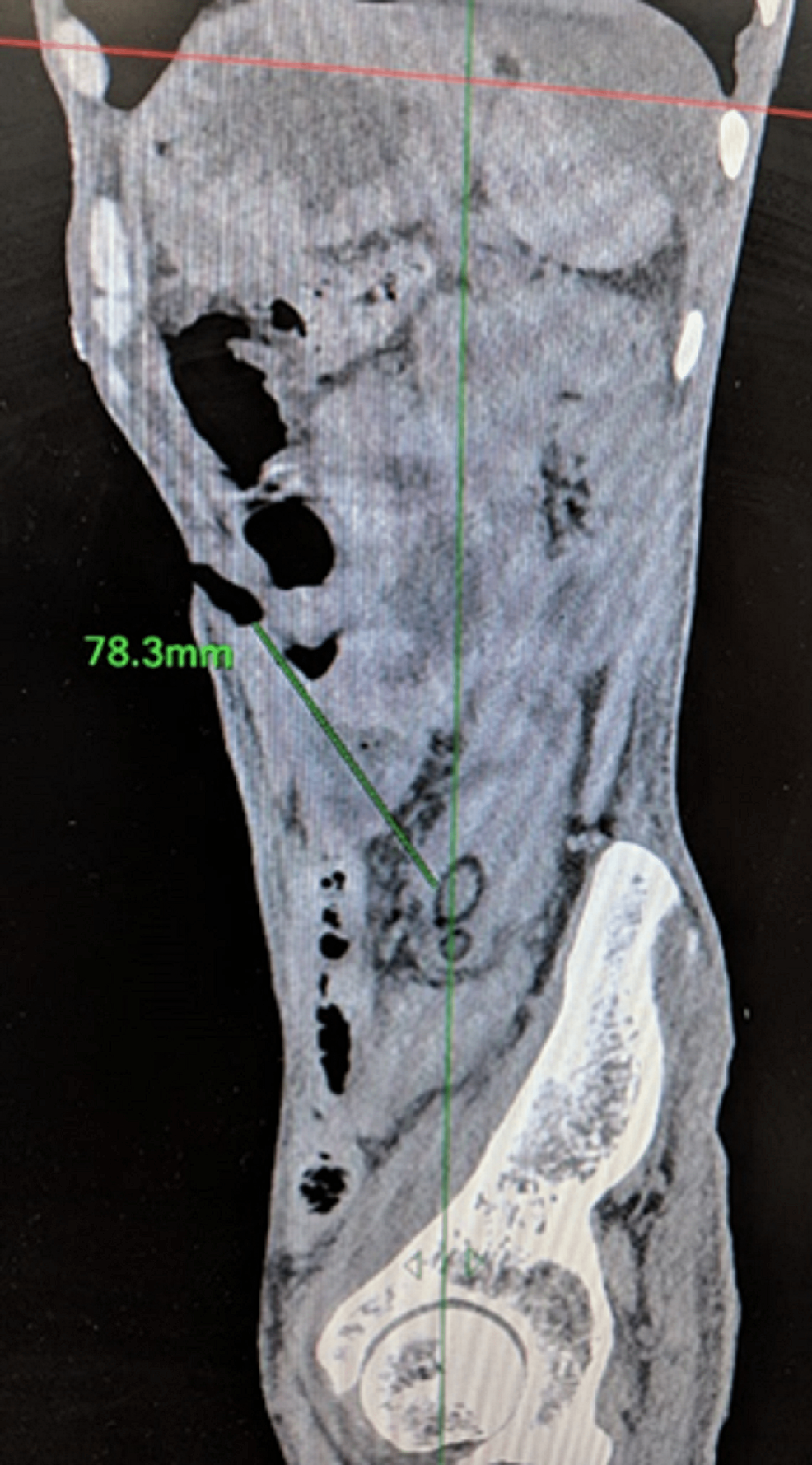 Cureus Spontaneous Enteral Migration of a Feeding Jejunostomy Tube