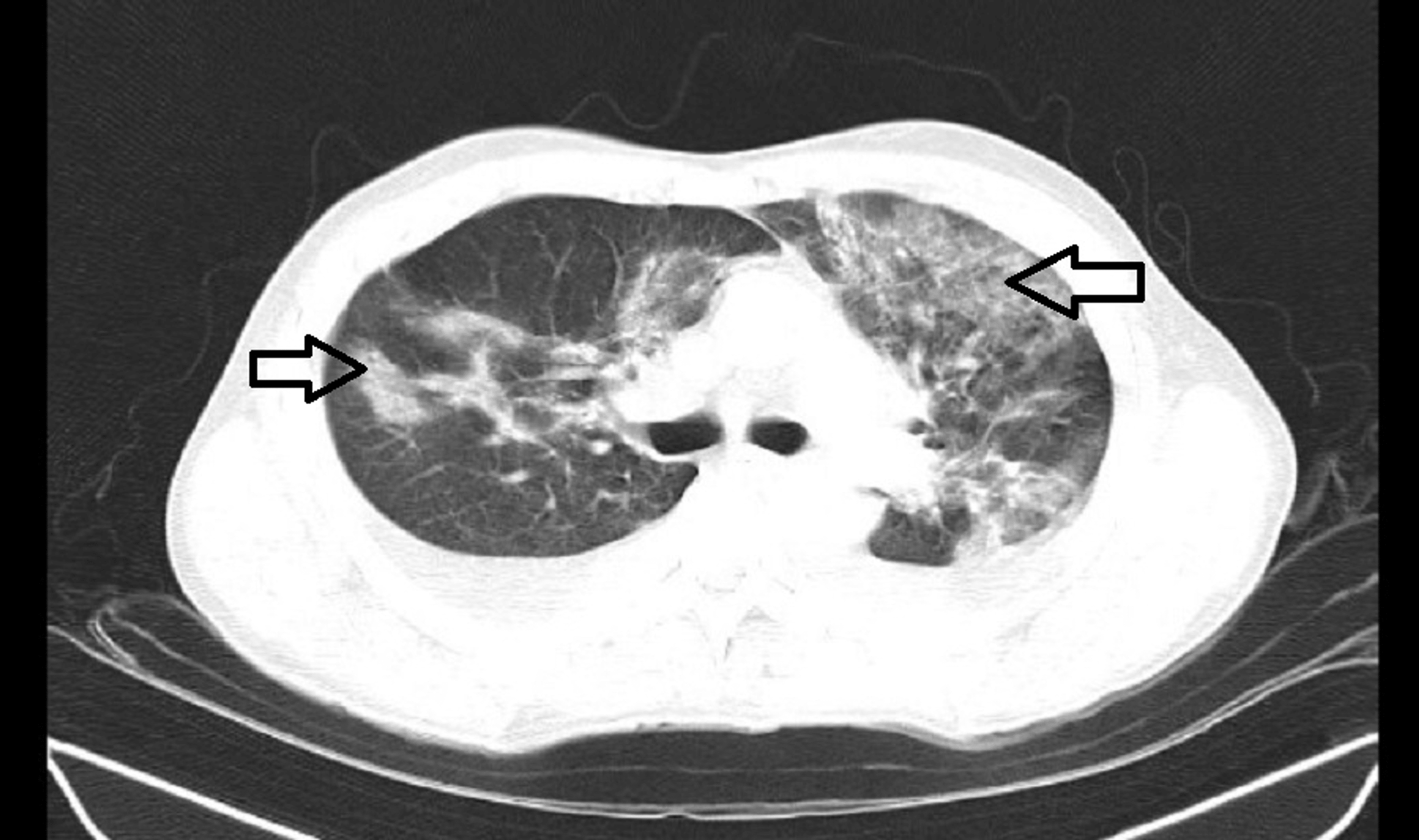 Lightning Strike Presenting As Fatal Lung Contusion: A Case Report | Cureus