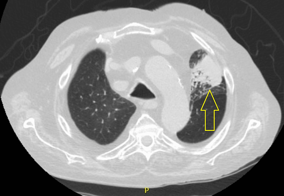 Chest-CT-scan-showing-left-upper-lobe-atelectasis