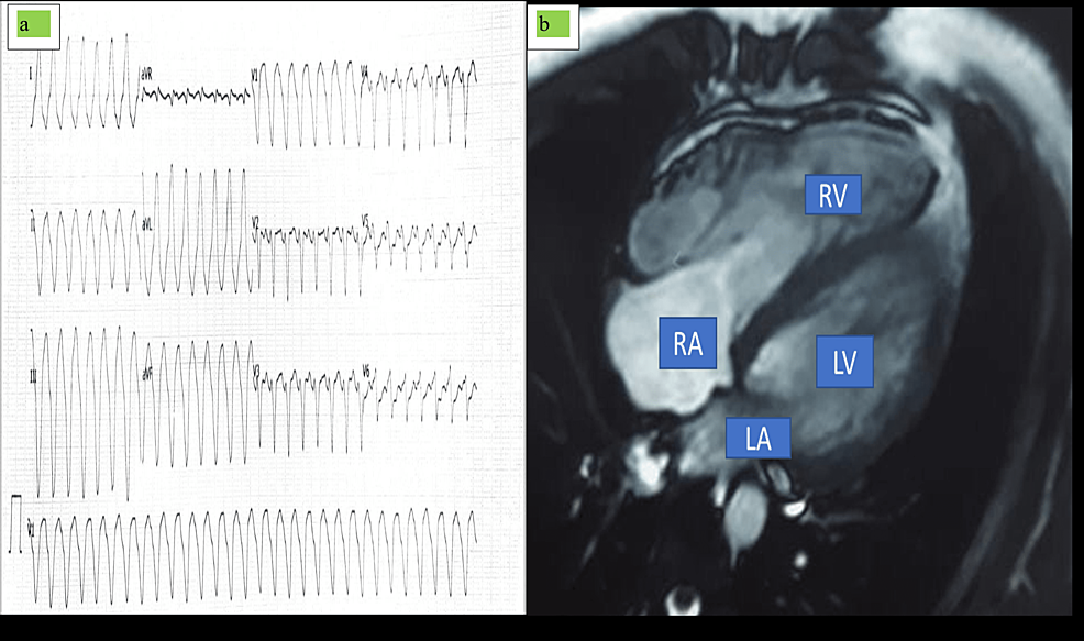 Cureus | Varied Presentation of Arrhythmogenic Right Ventricular