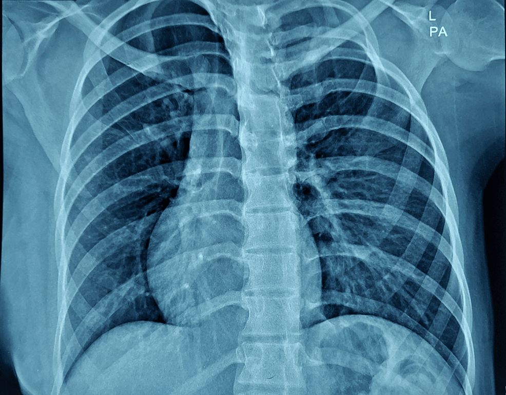 Clinical picture (A) Asymmetric chest with hypoplastic and