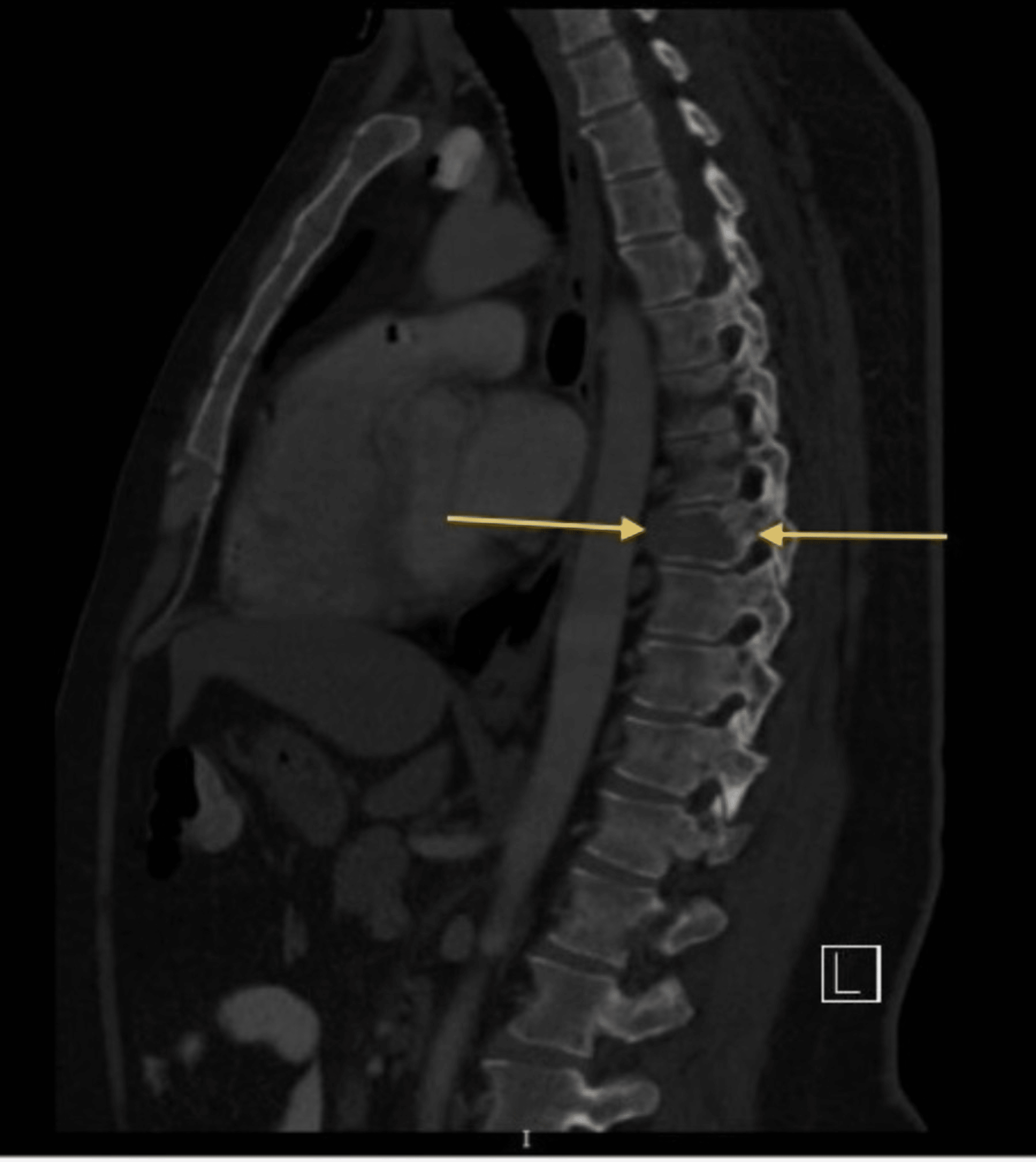 Cureus | Surgical Intervention for Spinal Lesions Due to Multiple ...