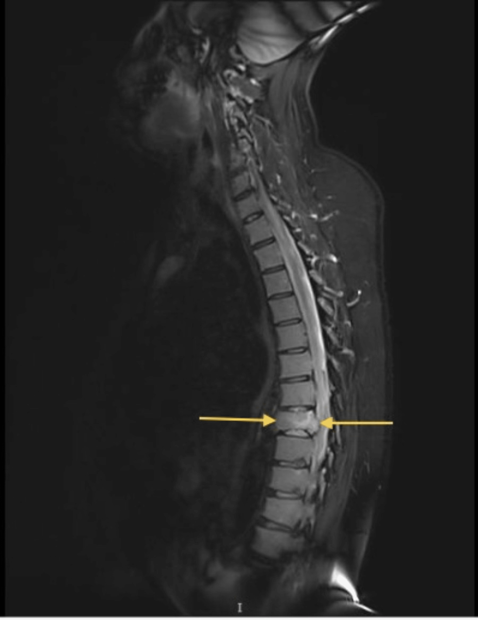 Cureus Surgical Intervention for Spinal Lesions Due to Multiple
