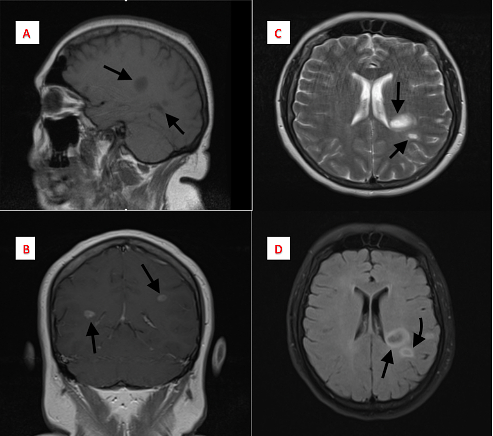 Cureus Tumefactive Multiple Sclerosis A Rare Variant Presenting As Multiple Ring Enhancing 1556