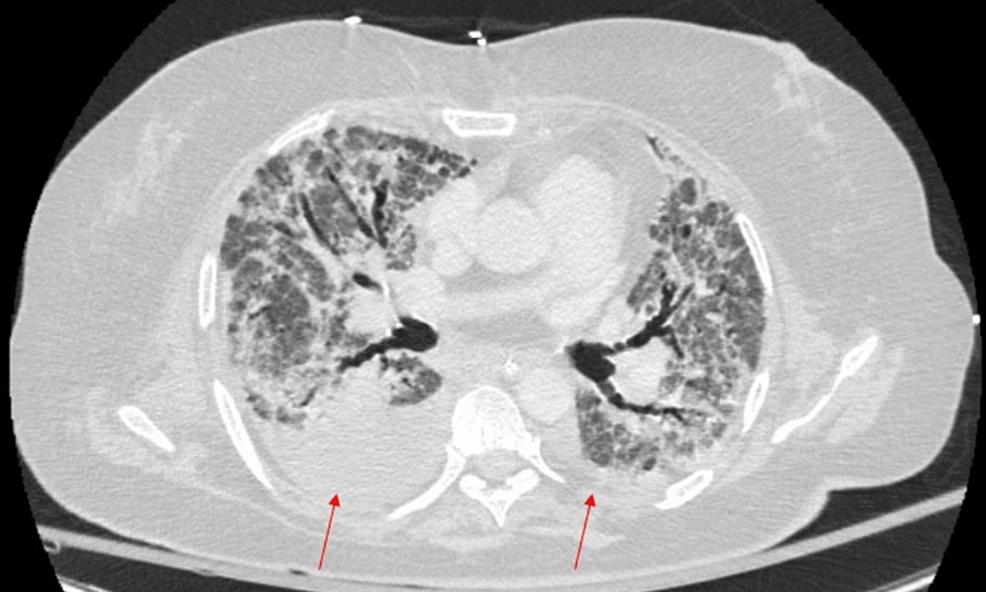 CT-thorax-with-contrast-showing-lung-fibrosis-and-moderate-right-and-small-left-pleural-effusion-(red-arrows).-