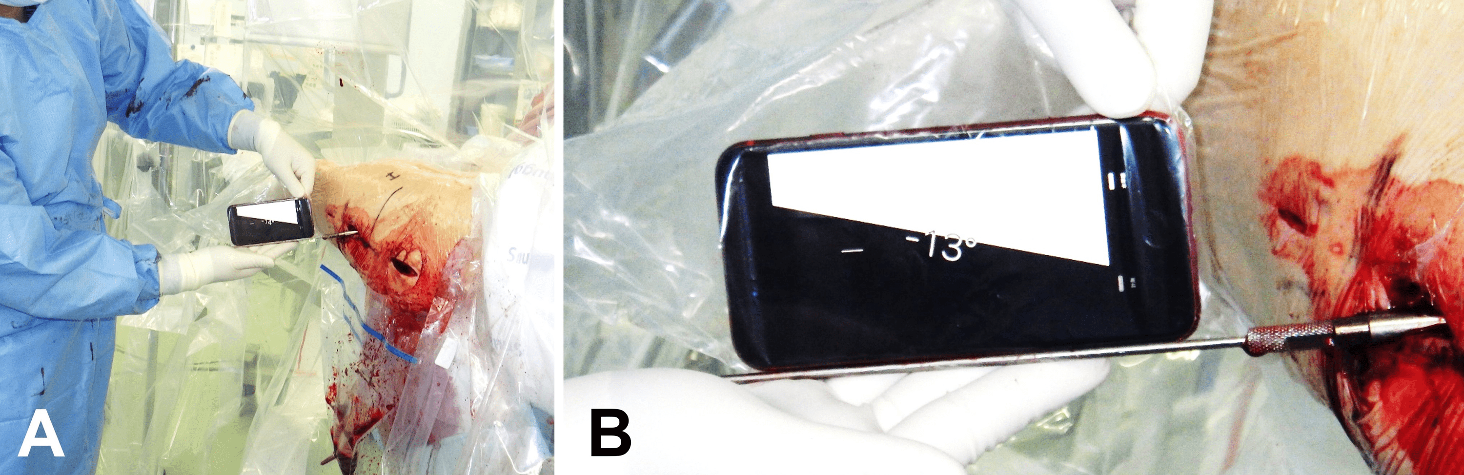 Cureus Measurement of LagScrew Anteversion With an iPhone During