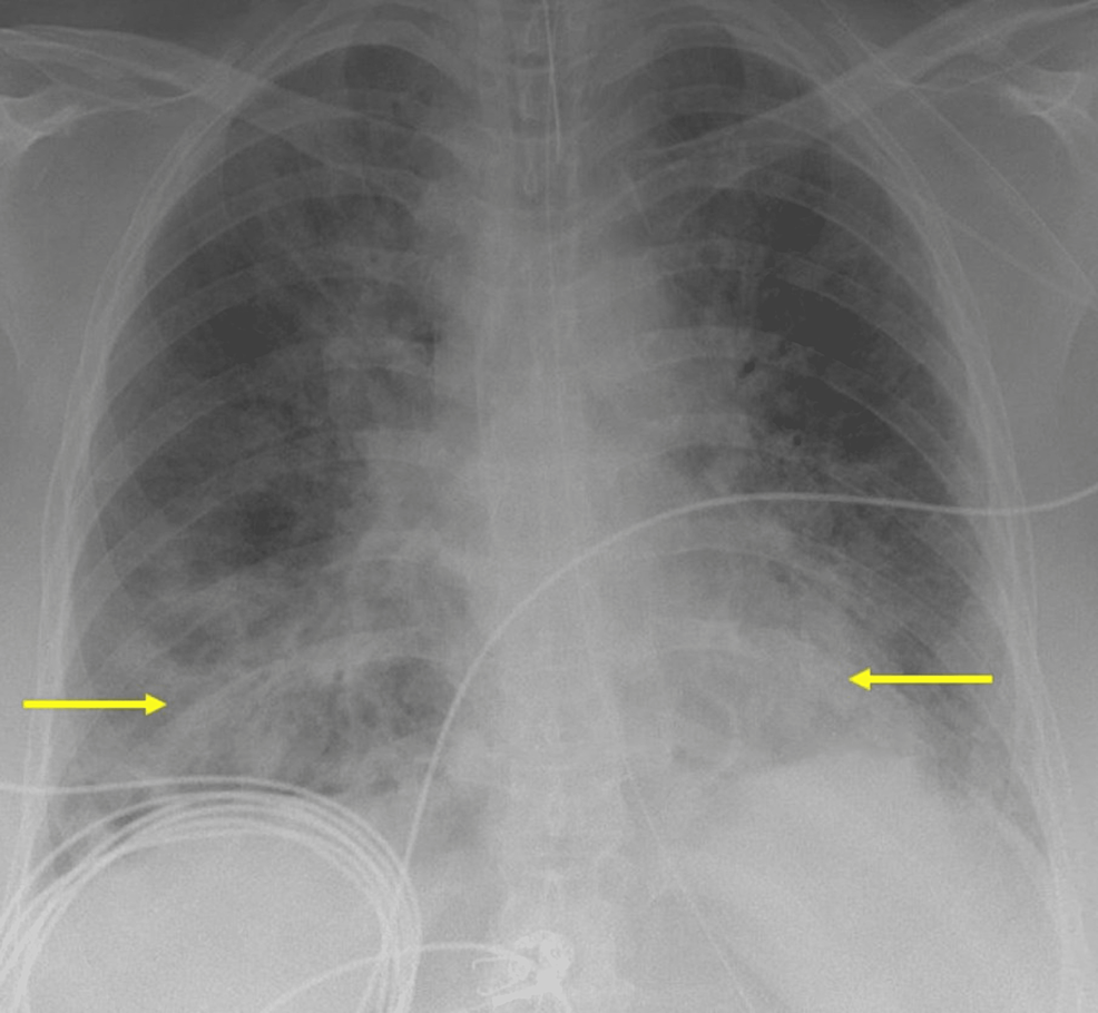 Chest-X-ray-demonstrating-bilateral-infiltrates-suggestive-of-COVID-19-pneumonia-(yellow-arrows).