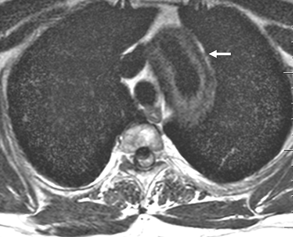 Resonancia magnética preoperatoria (T2 axial) que muestra una aorta torácica dilatada con una masa de tejido blando periaórtico (flecha).