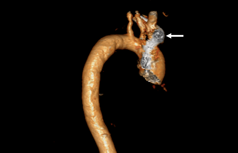 Aortograma-TC-preoperatorio-(3D)-que-muestra-una-aorta-dilatada-con-una-lesión-masa-periaórtica-(flecha).