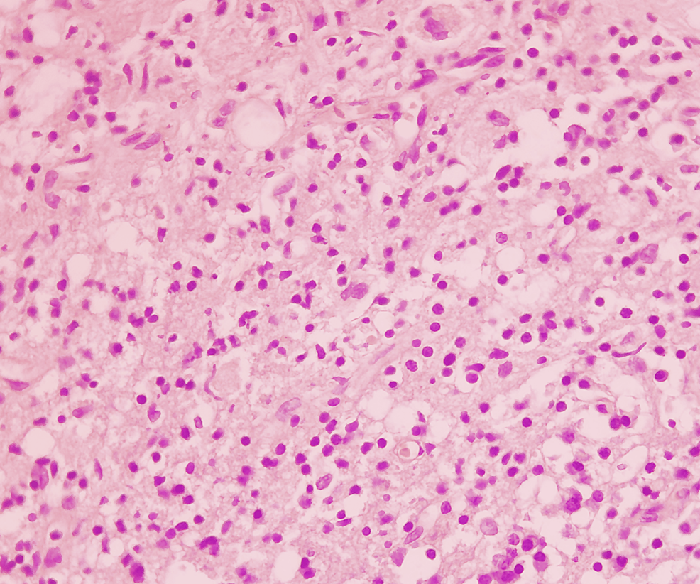 Tinción de hematoxilina-eosina-(x400)-de-la-muestra-de-tejido-de-la-lesión-de-masa-dural-que-muestra-un-infiltrado-inflamatorio-crónico-denso-compuesto-de-histocitos-linfocitos-espumosos ,-y-células plasmáticas.