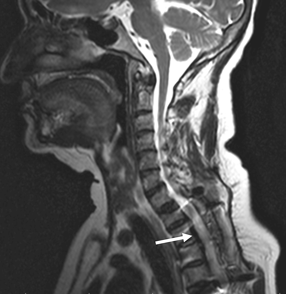 Resonancia magnética posoperatoria (T2-sagital) que muestra una resolución casi completa de la lesión de masa extradural (flecha).