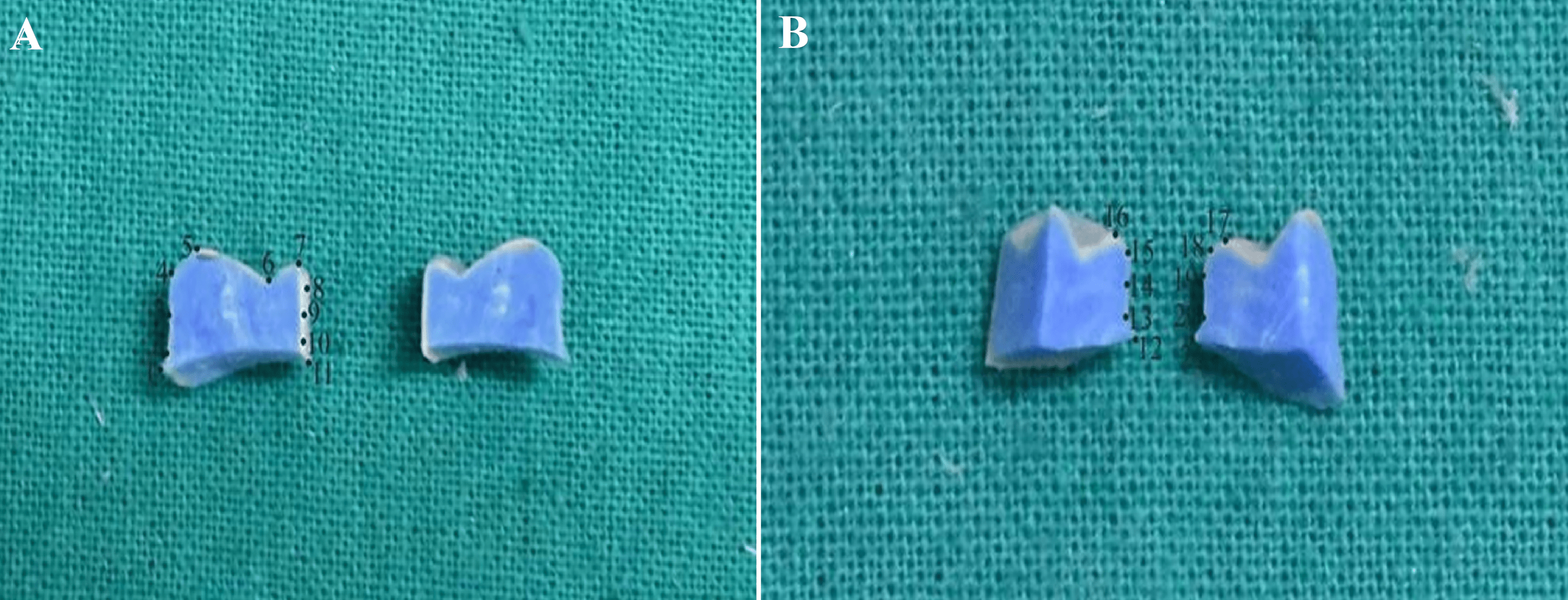 Cureus An In Vitro Comparison of Zirconia and Hybrid Ceramic Crowns