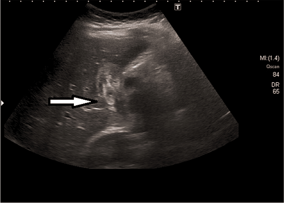 Ultrasound-of-a-Gallbladder-with-Ascariasis