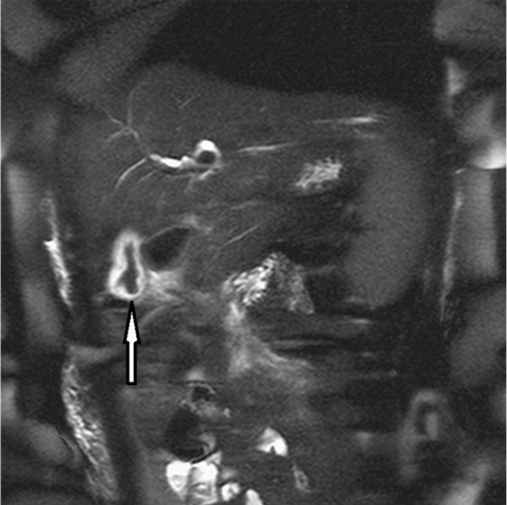 Abdominal-Magnetic-Resonance-Cholangiopancreatography-with-Appearance-of-Ascaris-worms-in-the-Gallbladder