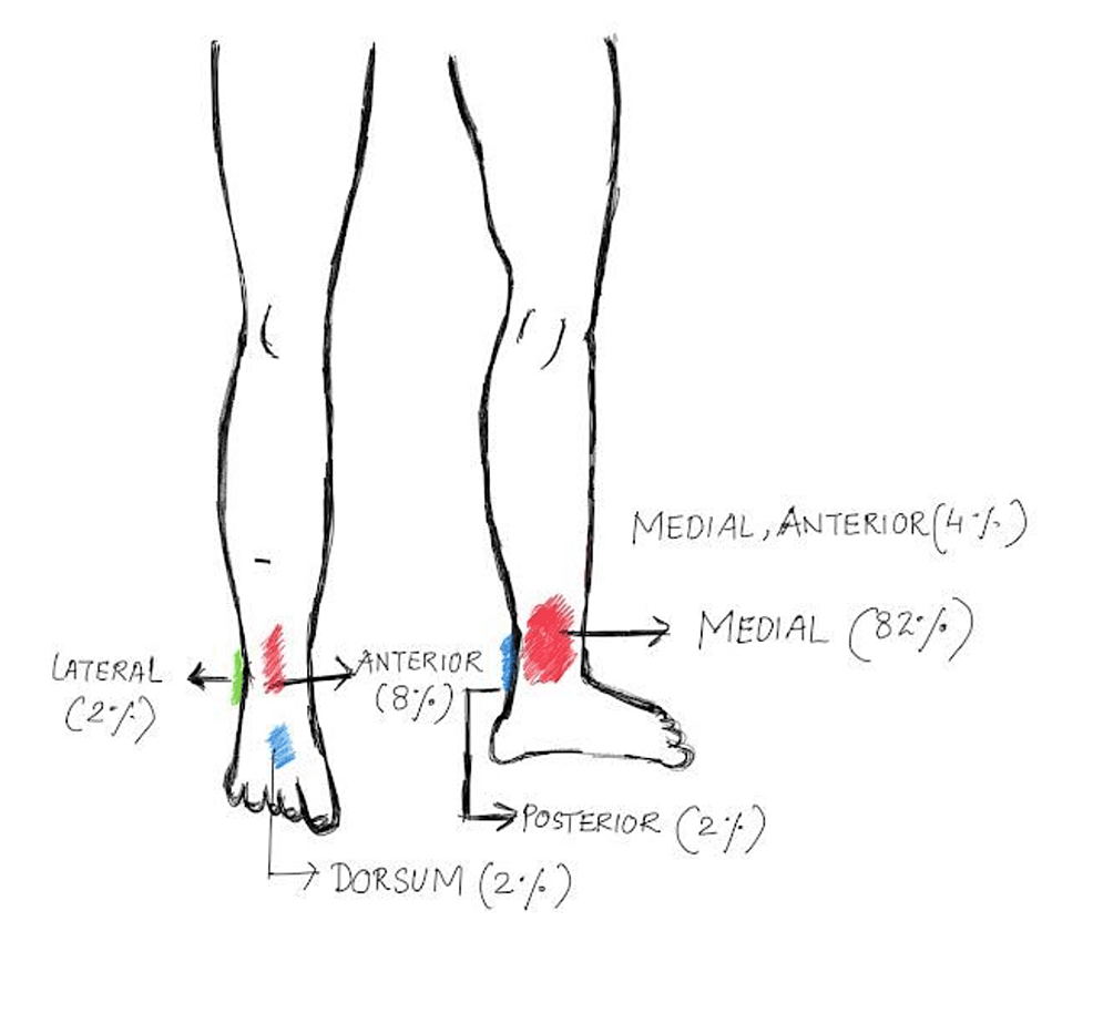 Cureus Effect of Endovenous Laser Ablation Along With Compression Therapy on Chronic Venous