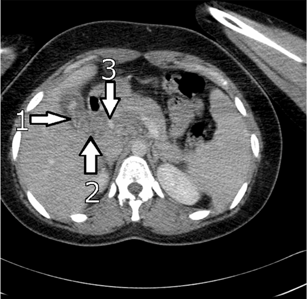 Abdominal-Computerized-Tomography-Scan-of-a-Gallbladder-with-Ascariasis