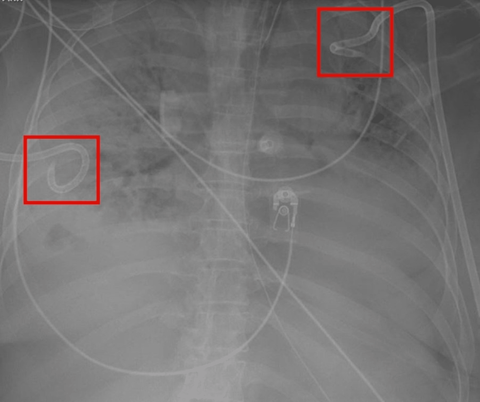 Chest-X-ray-demonstrating-complete-opacification-of-the-patient's-lungs.-The-red-squares-demonstrate-the-chest-tubes.
