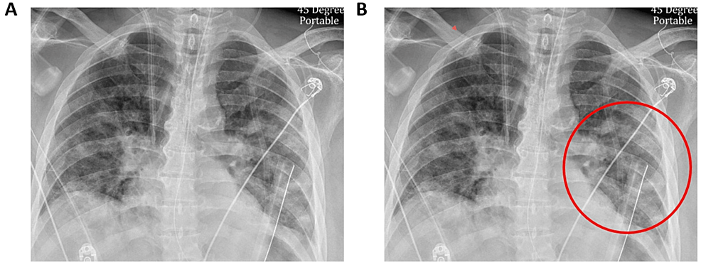 CXR-prior-to-intubation-(A)-and-after-re-intubation-(B).-The-red-circle-represents-worsening-infiltrates-on-the-left-side-compared-to-the-right.