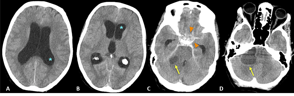 The subarachnoid hemorrhage (SAH) stages. The yellow arrows