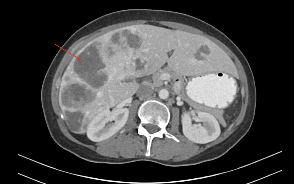 Cureus, A Rare Case of Breast Metastatic Gastrointestinal Stromal Tumor