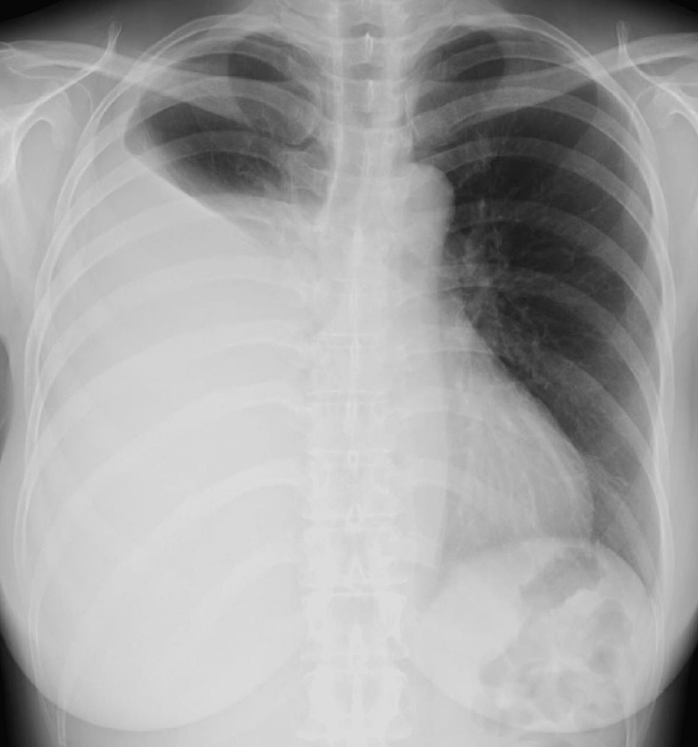 Pseudo-Meigs’ Syndrome in a Patient With Uterine Fibroids With Massive ...