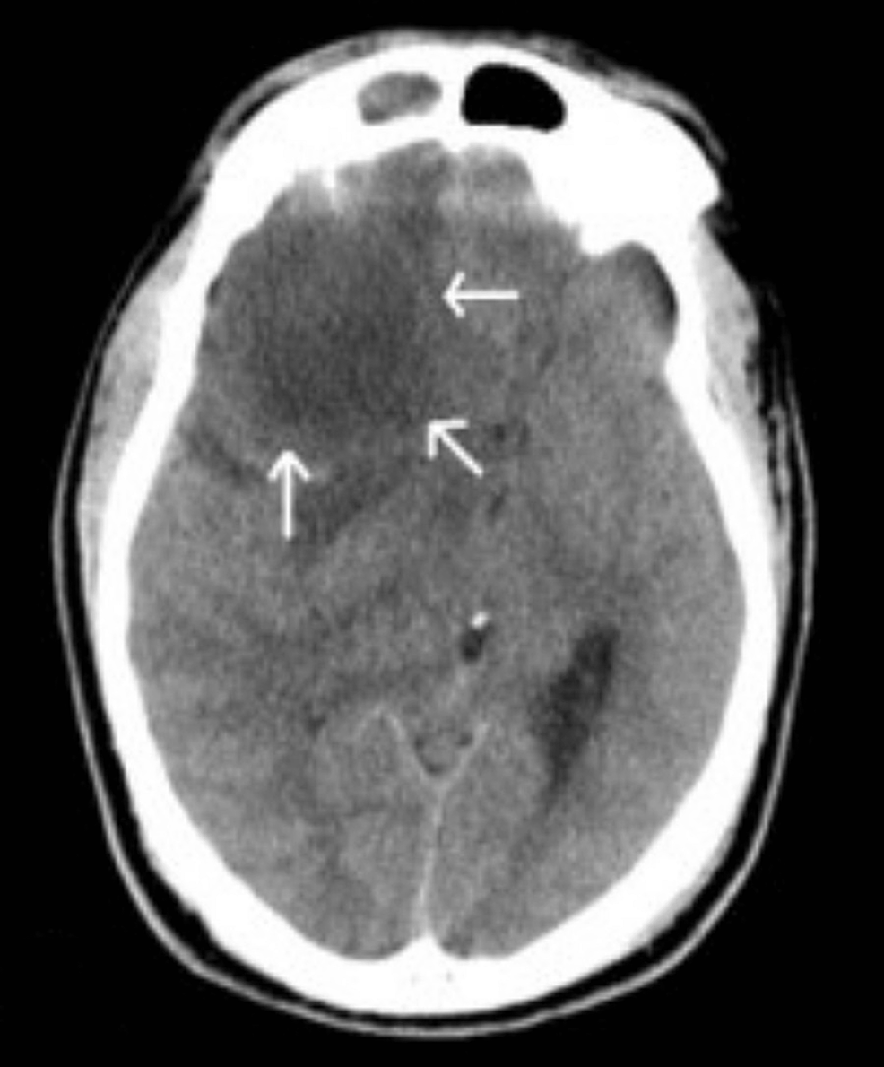 pott-s-puffy-tumor-a-forgotten-complication-of-sinusitis-report-of