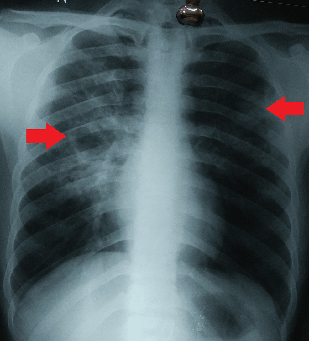 Cureus CycloserineInduced Insomnia and Psychosis in Multidrug