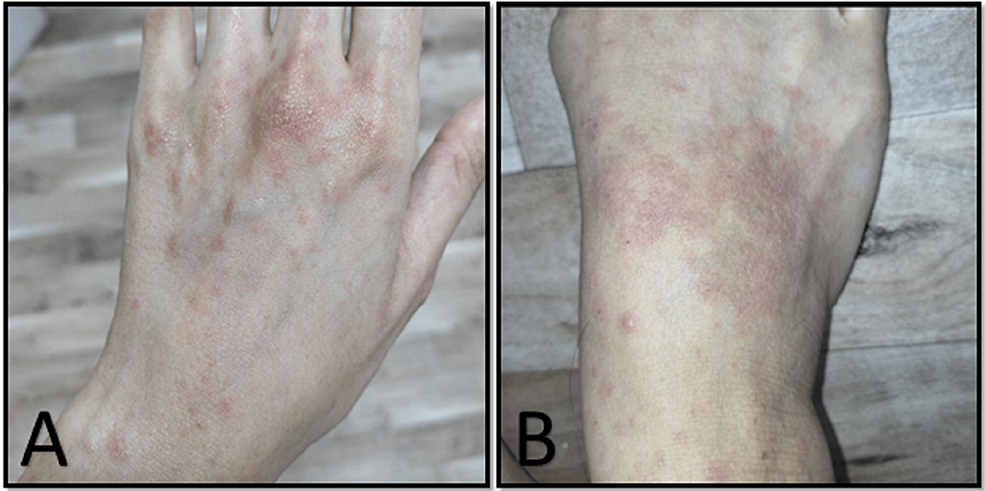 Atypical Presentation Of Scarlet Fever Cureus