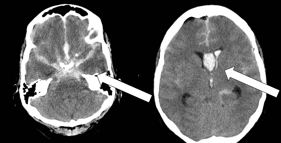 Early CT imaging (left) and intraventricular extension (right) of an identified diffuse subarachnoid hemorrhage.