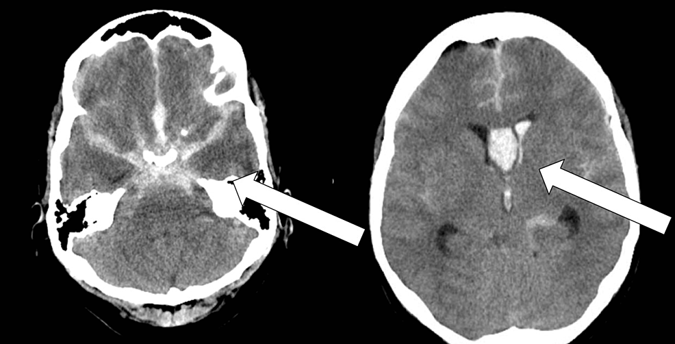 Subarachnoid Hemorrhage (SAH) - Brain, Spinal Cord, and Nerve