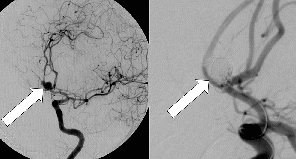 Angiogram of ACoM aneurysm (left) and result after coiling (right).