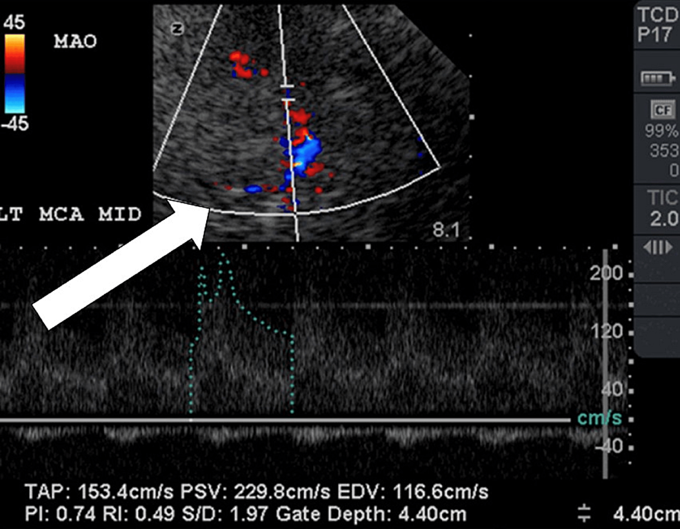 TCD-on-POD-7- MCA with moderate vasospasm.