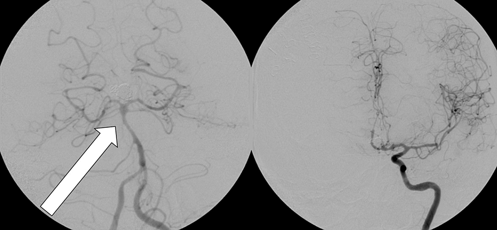 Severe basal, -ACA-A1- (left), and -MCA-M1- (right)-vasospasm.