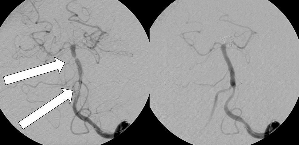 Balloon angioplasty performed for vasospasm on 2 consecutive days.  -Segment-of-MCA- (left).-Post-balloon-angioplasty-results-of-the Basilar- (right).