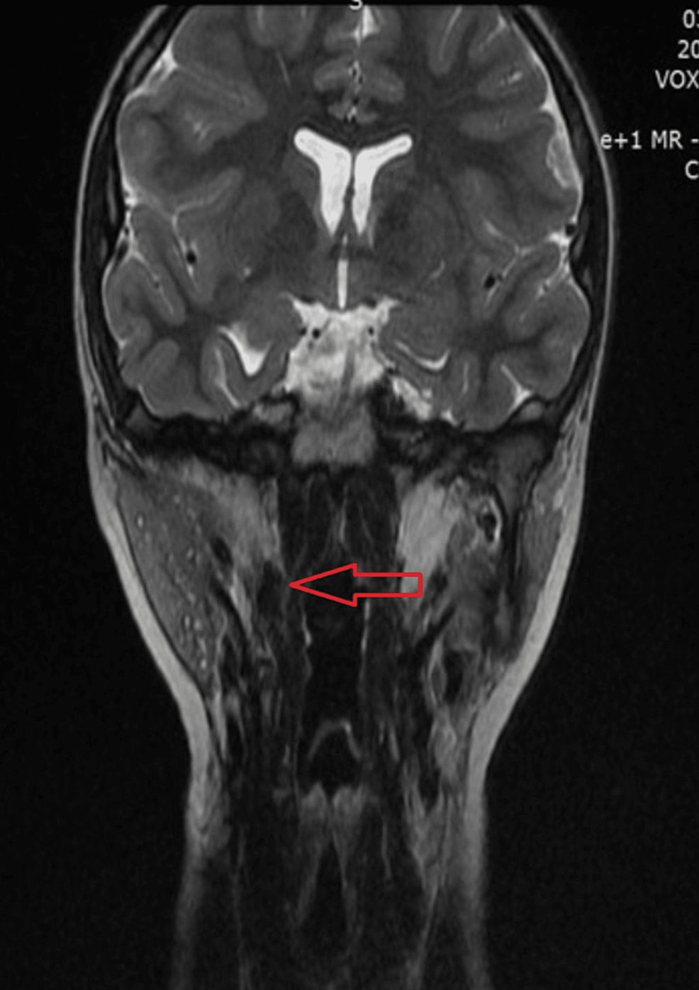 Retropharyngeal Ectopic Thymus in a Pediatric Patient With 22q11.2