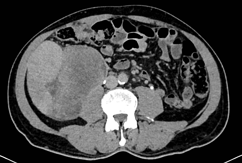 Cureus Primary Retroperitoneal Smooth Muscle Tumor of Uncertain