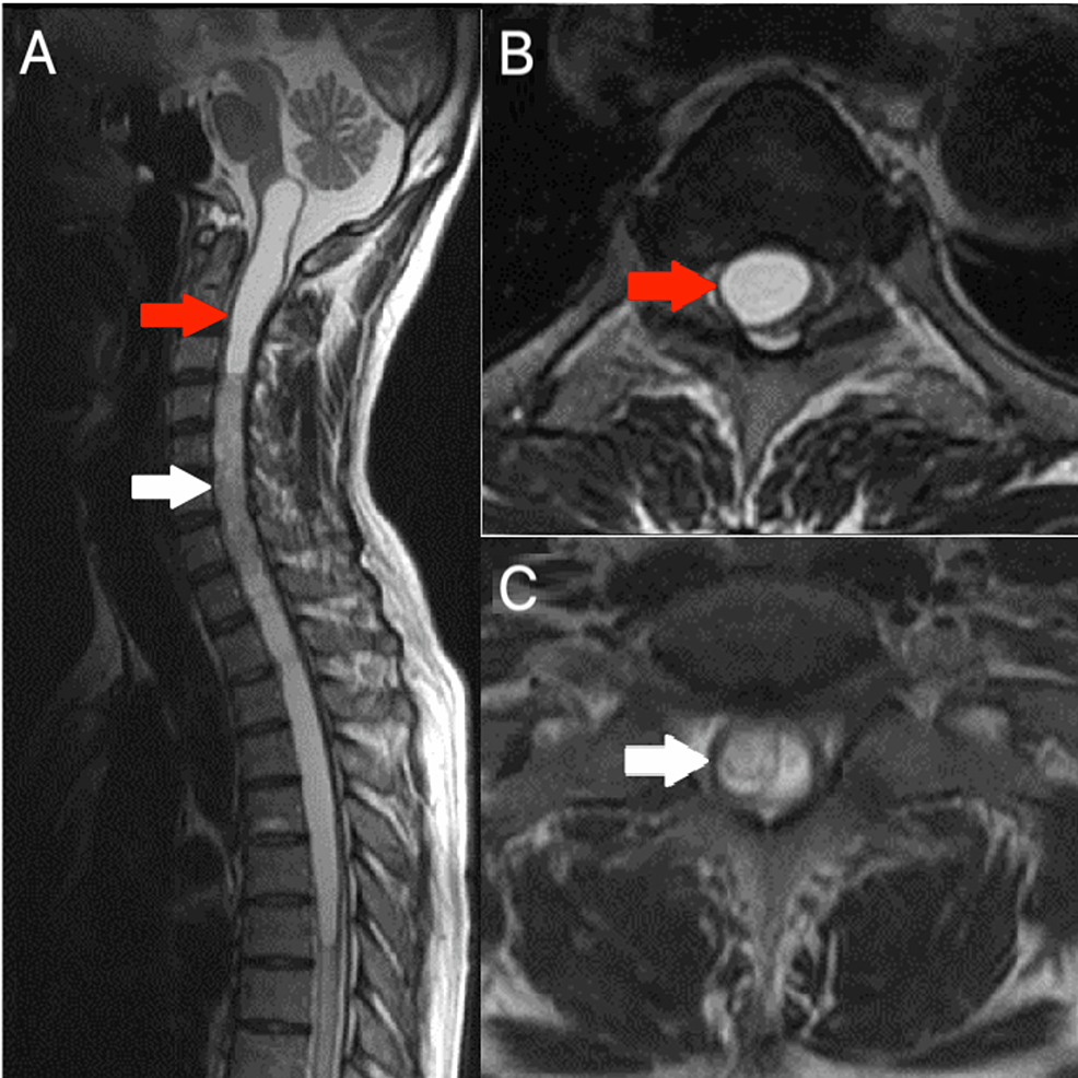 T2-weighted-MRI-in-the-sagittal-plane-(A)-shows-tumors-from-C4-C7-(white-arrow)-with-syringomyelia-upper-and-lower-tumor-(red-arrow),-corresponding-to-the-axial-plane-through-the-syringomyelia-(B)-and-through-the-tumor-with-multicystic-components-(C).