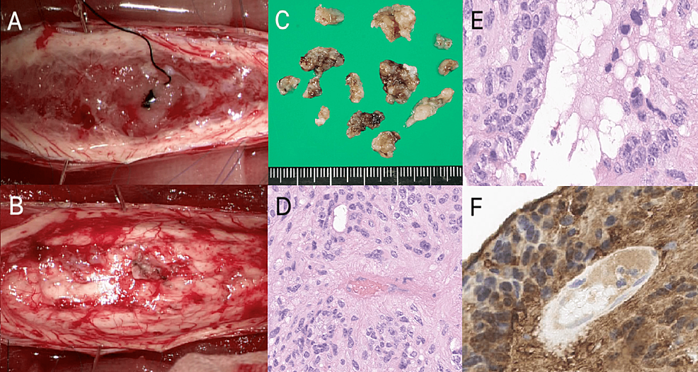 Imaging-of-the-intramedullary-tumor-during-surgery-(A),-full-dissection-of-the-tumor-(B),-and-cutting-of-the-tumor-into-perivascular-pseudorosette-for-histology-(C).-(D).-The-massive-cell-has-eosinophilic-cytoplasm,-eccentrically-positioned-single-or-multiple-nuclei-with-noticeable-nucleoli-(D),-and-intranuclear-cytoplasmic-inclusions-(E).-The-immunohistochemistry-stain-GFAP-revealed-the-presence-of-tumor-cells-(F).