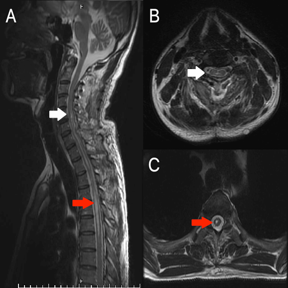 Postoperative-T2-weighted-MRI.-The-tumor-is-completely-removed-on-the-sagittal-plane-(A)-and-the-axial-plane-at-C5-(B,-white-arrow)-and-at-the-T4-T5-level-corresponds-to-the-syringomyelia-(C,-red-arrow).