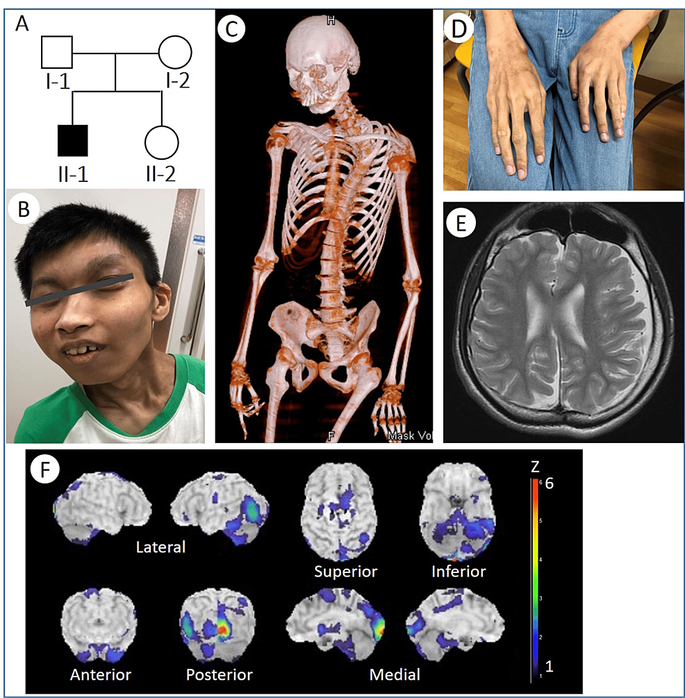 Cureus, Whole-Exome Sequencing Identified a Novel DYRK1A Variant in a  Patient With Intellectual Developmental Disorder, Autosomal Dominant 7