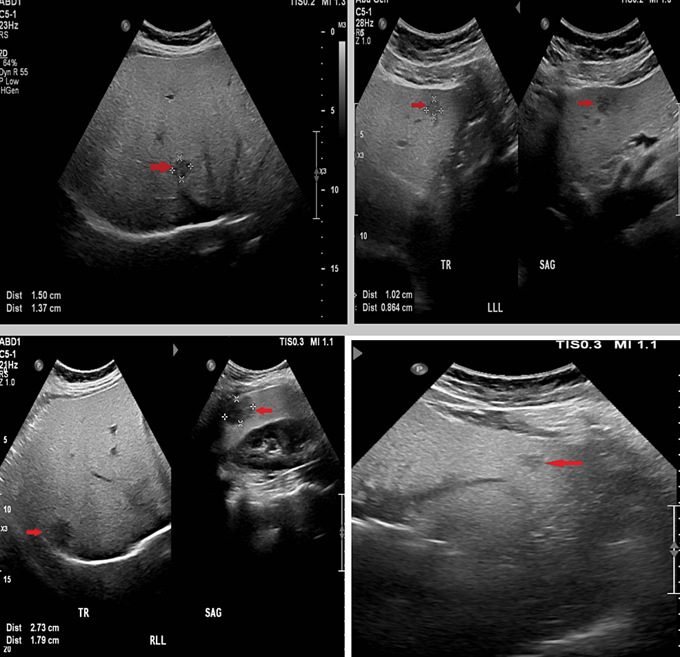 fatty liver ultrasound