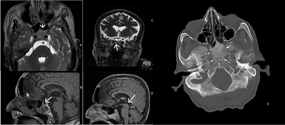 Axial-(A)-and-coronal-(B)-T2-weighted-images,-and-sagittal-T1-weighted-images-before-(C)-and-after-(D)-contrast-administration.-The-lesion-has-a-heterogeneous-signal-on-spontaneous-T1-(C)-and-T2-images-(A-and-B)-–-it-is-slightly-hyperintense-on-T2-and-markedly-hyperintense-on-T1-peripherally,--and-iso/hypointense-on-T2-and-hypointense-on-T1-centrally.-On-postcontrast-images,-there-is-a-diffuse-enhancement-(D).-Axial-bone-window-CT-image-showing-an-ill-defined-ground-glass-density-lesion-centered-in-the-clivus,-with-loss-of-normal-bone-cortication;-The-lesion-has-a-maximum-antero-posterior-extension-of-35mm,-but-there-is-no-significant-mass-effect.-(1-E)