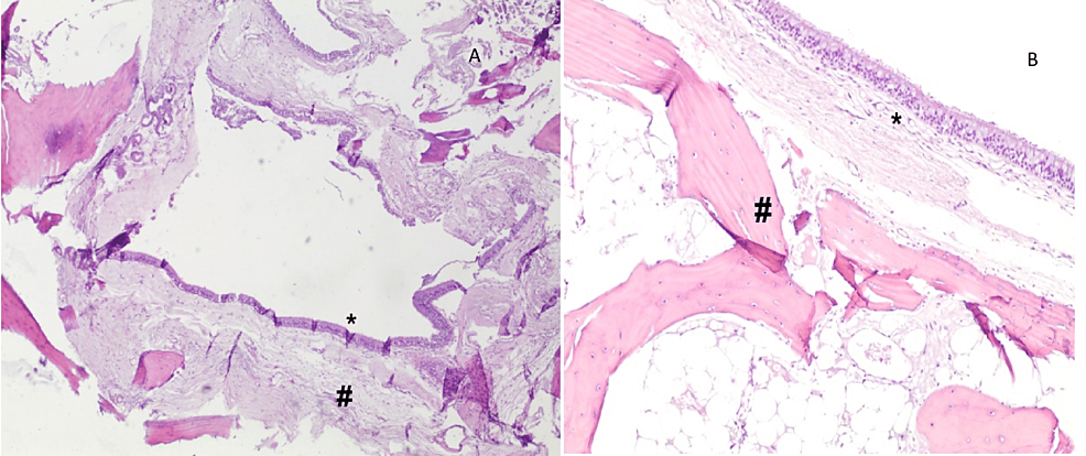 Cystic-lesion-surrounded-by-bone-tissue-and-lined-by-respiratory-epithelium-with-no-atypia,-consistent-with-the-diagnosis.-Respiratory-type-epithelium-lining-cyst-(*),-surrounded-by-mature-osseous-bone-(#).-A:-40x,-B:-100x