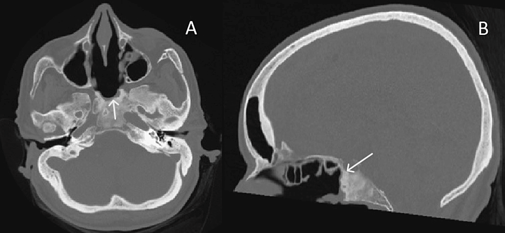 Axial-(A)-and-sagittal-(B)-bone-window-CT-images-of-the-same-patient,-after-endoscopic-surgical-approach.-There-was-partial-removal-of-the-lesion.