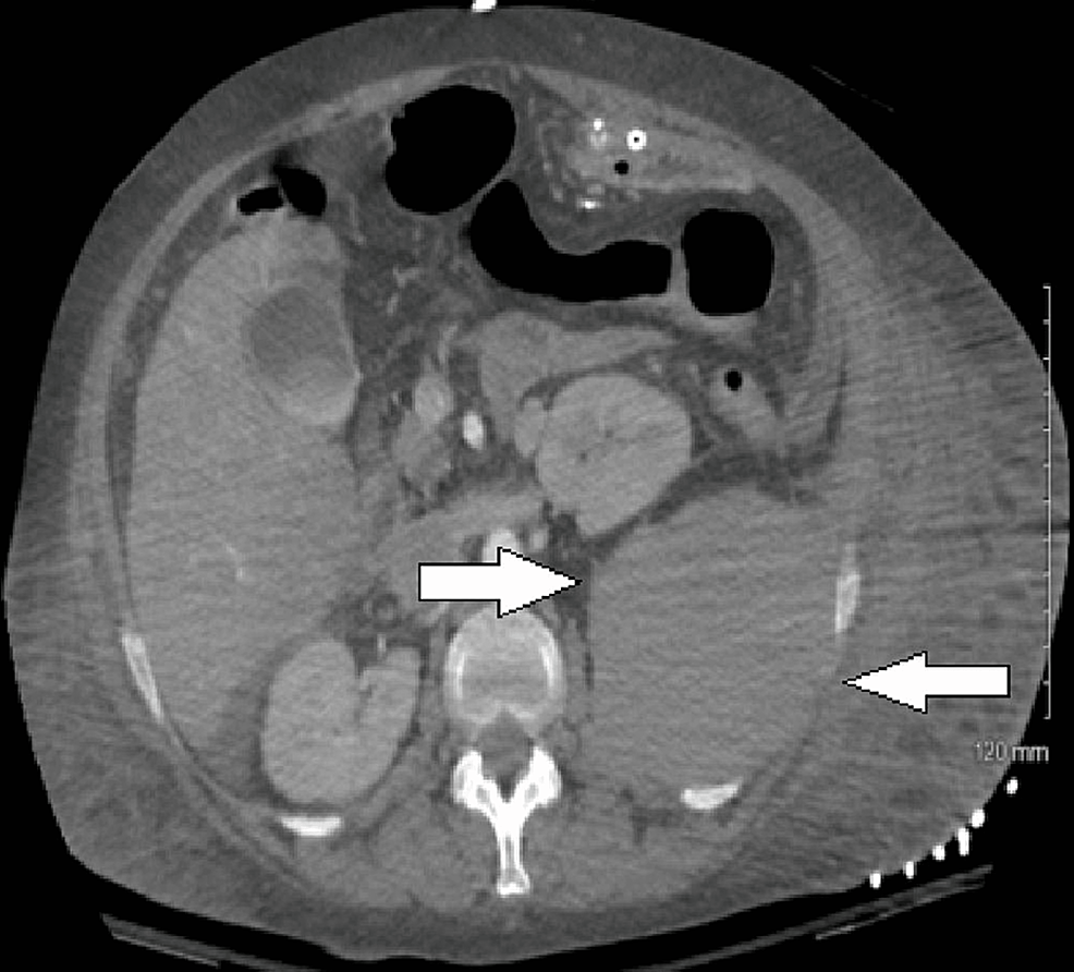 Sudden onset flank pain: a case report of retroperitoneal hemorrhage s