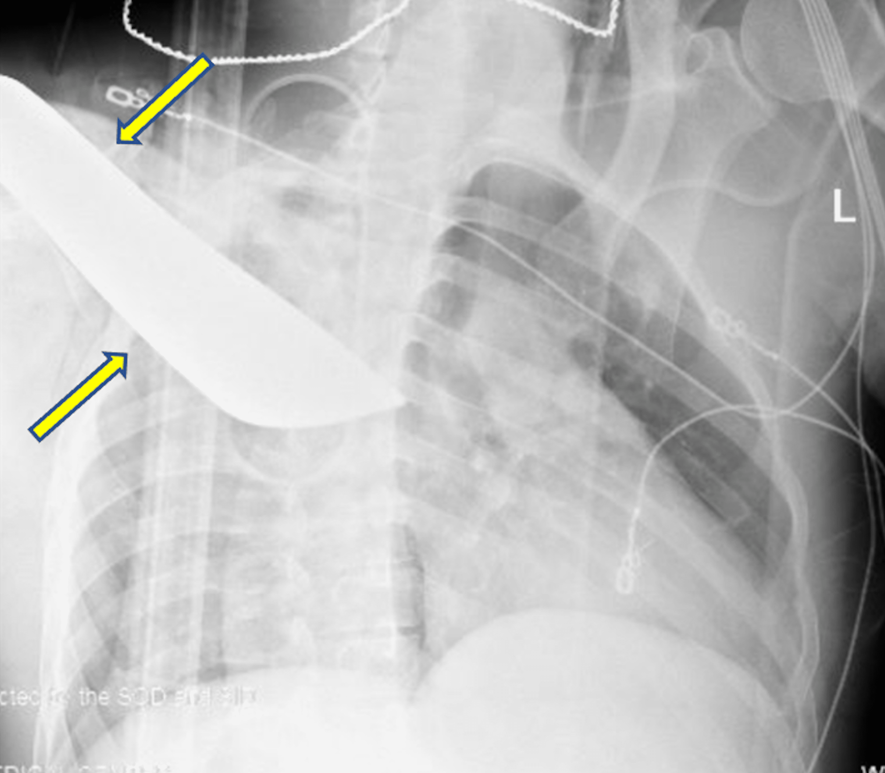 A Non Fatal Impalement Injury To The Right Thorax A Case Report Cureus a-non-fatal-impalement-injury-to-the-right-thorax-a-case-report-cureus