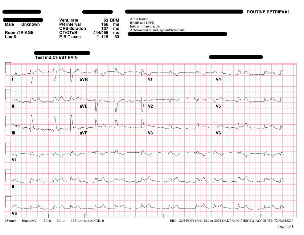 Initial-ECG-showing-atrial-flutter-and-variable-block-with-ST-elevation-in-lead-II-and-to-a-lesser-extent-in-aVF/V5/V6-without-reciprocal-changes.-Serial-ECGs-in-the-emergency-department-showed-resolution-of-the-ST-elevations.