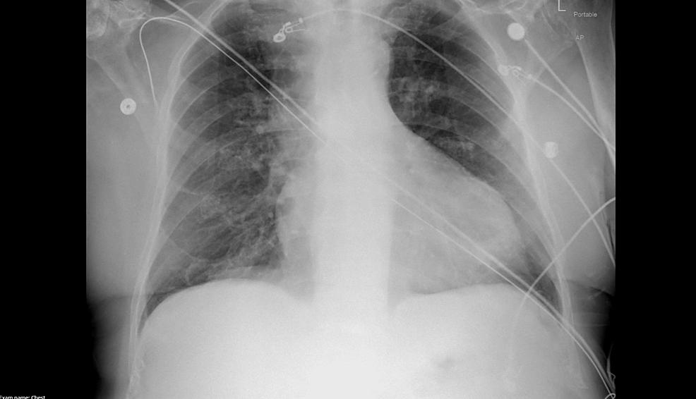 Initial-chest-X-ray-significant-for-mild-cardiomegaly-with-left-ventricular-prominence-